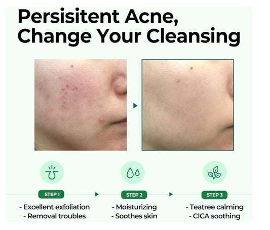 SOME BY MI AHA, BHA, PHA 30 Days Miracle Cleansing Bar | Savon Nettoyant Miracle Eclaircissant