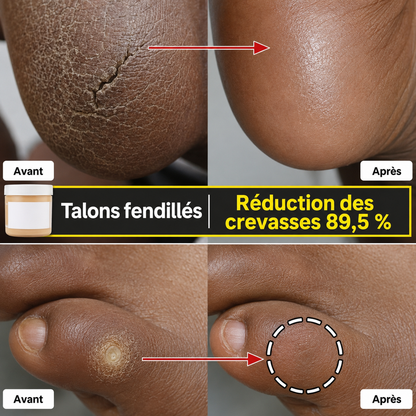 MEDIPEEL EGF Scaling Moisture Foot Cream 2.0 | Crème Pieds Réparatrices Callosités Zone rugueuses